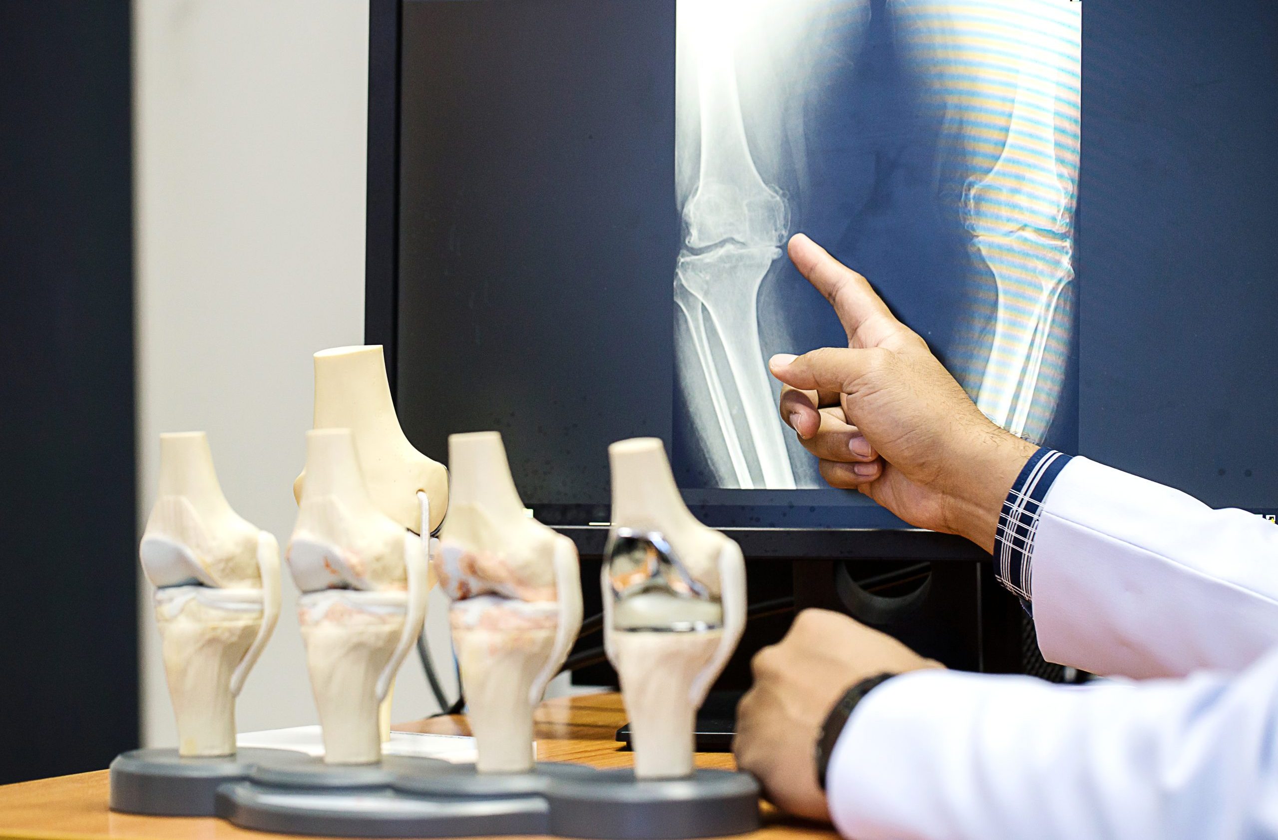 Doctor pointing on the knee problem point on x-ray film. x-ray film show skeleton knee on film. Surgery medical technology concept. Osteoarthritis in the elderly.